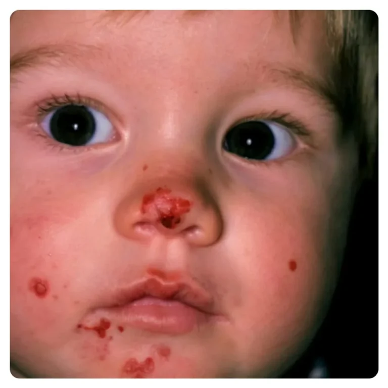 Niño pequeño con lesiones rojas en la nariz y la barbilla