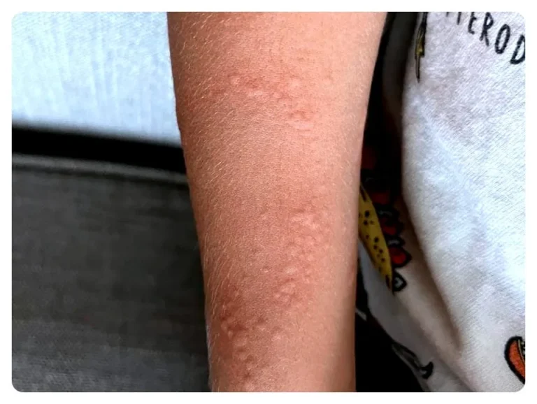 Brazo con manchas rojas y pequeñas lesiones