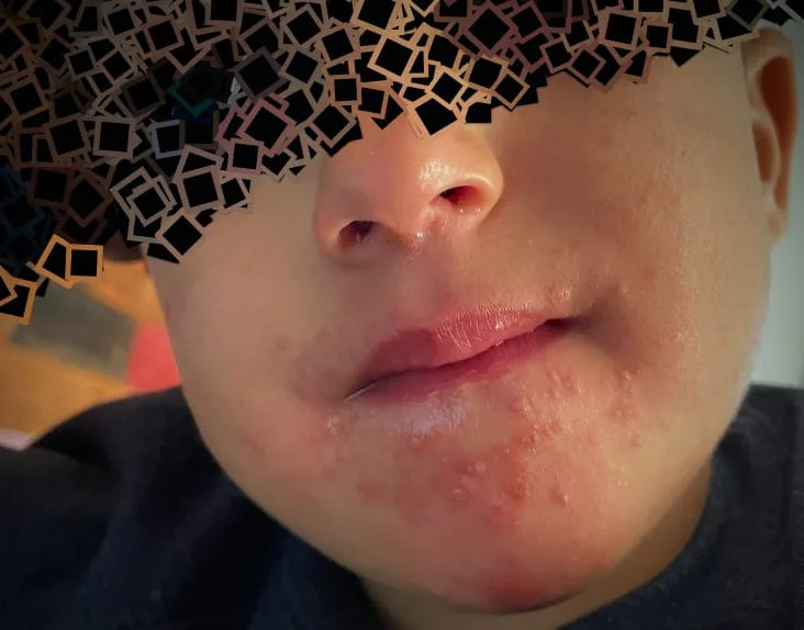 Rostro de un niño, con los ojos ocultos, con lesiones junto a la boca